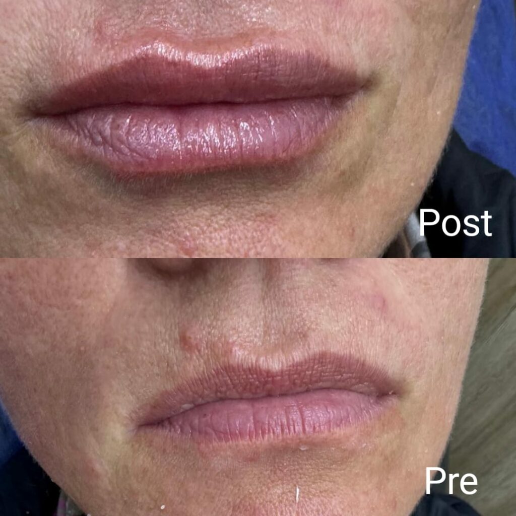 حقن الهيالون فيلر في الغردقة